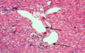 Figure 10: Photograph of a kidney section from +ve control (diabetic) showing marked degeneration of the glomeruli and severe vacuolations (→). H&E staining