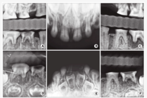 Figure 2: Case 1: The proband of the 5-year-old girl belonging to the DGI-II family has radiographic oral manifestation of DGI-II.