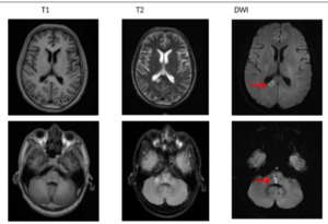 Figure 2: The head MRI scan and diffusion examination revealed an acute and subacute lacunar infarction of the corpus callosum and pons and multiple lacunar cerebral infarctions in the brain