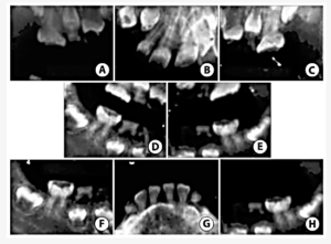 Figure 3 Case 2: Non-digital radiographs obtained while the patient was in the hospital under general anaesthesia (GA)