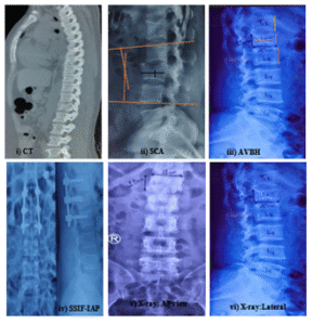 i) CT showing L1 Burst fracture. ii) L3 Burst fracture, SCA (Sagittal Cobb’s angle) calculation. iii) AVBH (anterior vertebral body height) calculation. iv) SSIF-IAP (short segment internal fixation with inclined angle poly axial) screw. v) X-ray: LS spine anteroposterior view. vi)X-ray: LS spine lateral view.