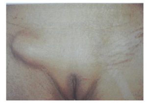 Female Inguinal Hernia (rt. side)