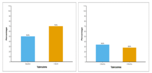 Figure showing prevalence of tuberculomas through 6 months follow-up.