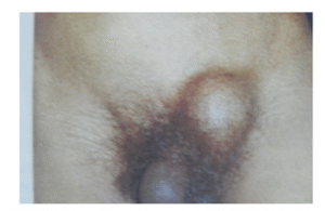Inguinal Hernia (lt. side) (2)