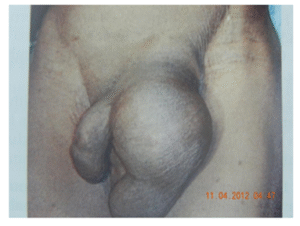 Inguinal Hernia (lt. side)