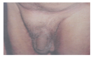 Inguinal Hernia (rt. side) (2)