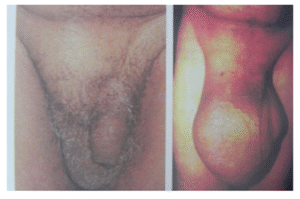 Inguinal Hernia (rt. side)