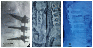 a) SSIF-IAP (short segment internal fixation with inclined angle poly axial) screw. b) SSIF-SFM (short segment internal fixation with straight forward monoaxial) screw. c) LSIF (long segment internal fixation) screw.