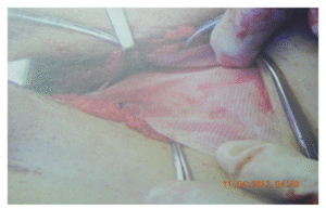 With Mesh Repair Hernia (lt. side)