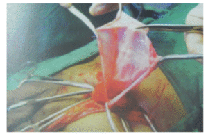 With Non-Mesh Repair Hernia (lt. side)