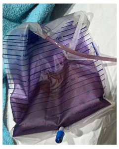 Purple urine discoloration shown in the catheter bag and tubing’s