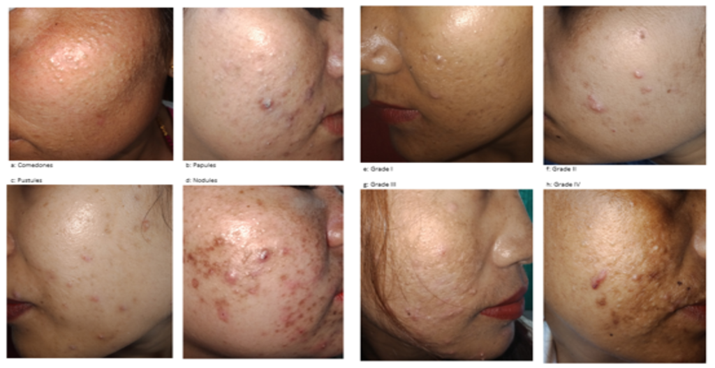Clinico-epidemiological Profile of Adult Acne and factors Associated with Adult Acne